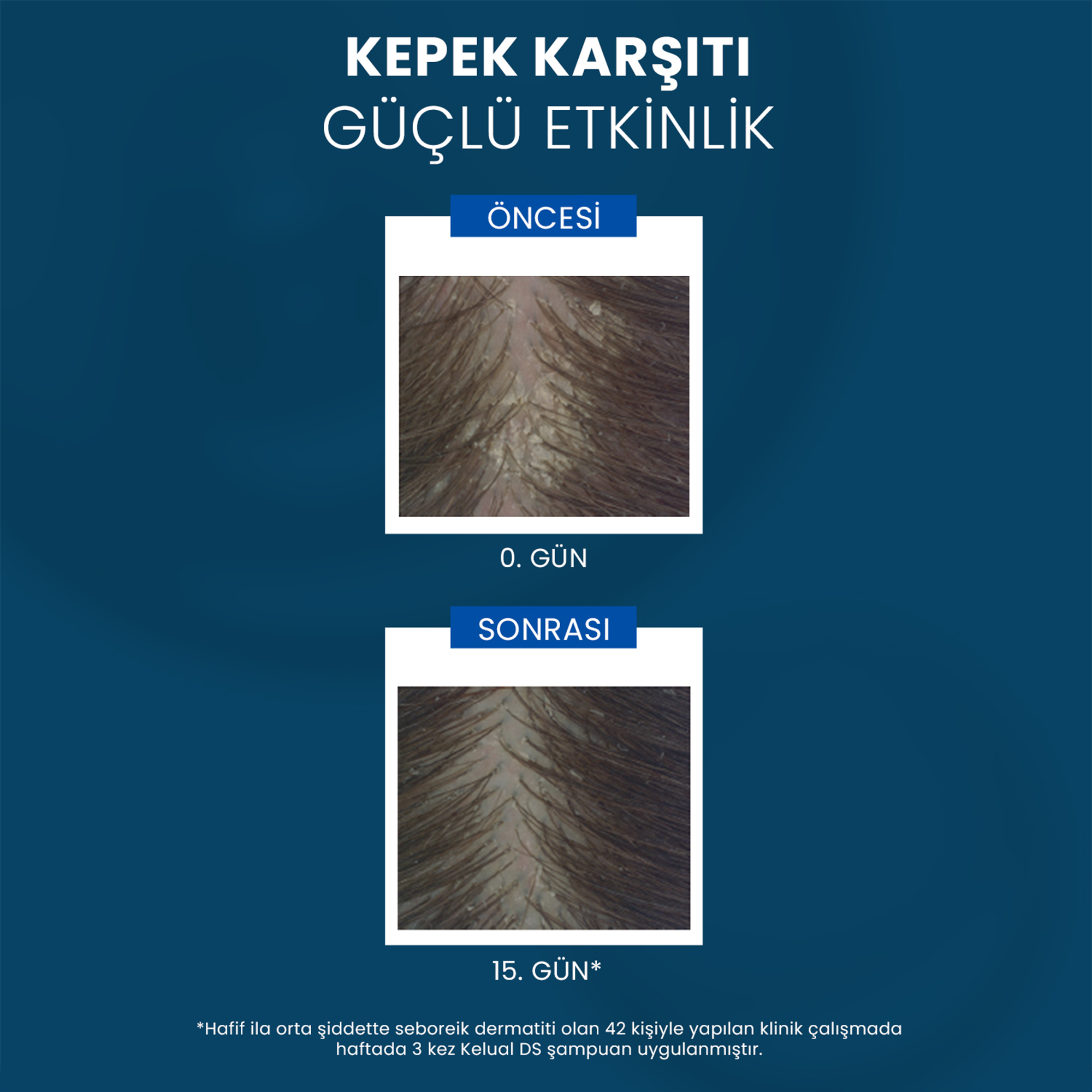 Ducray Kelual DS İnatçı Kepek Karşıtı Şampuan 100 ml – Kepeğe karşı etkili 100 ml'lik Ducray Kelual DS şampuan.
