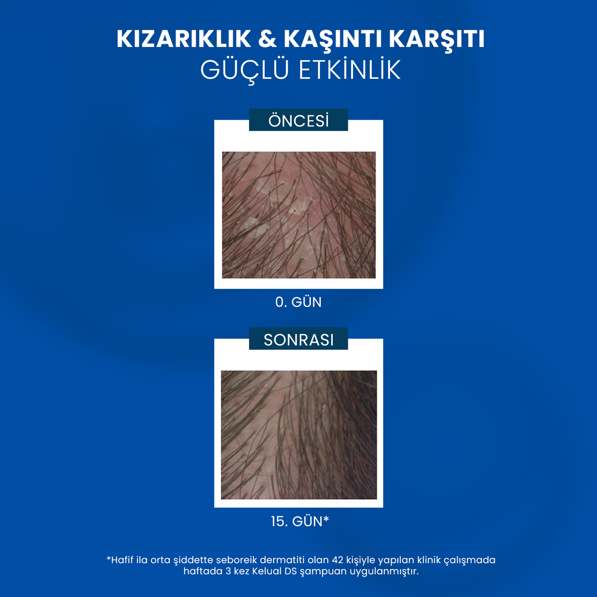 Ducray Kelual DS İnatçı Kepek Karşıtı Şampuan 100 ml – Ducray Kelual DS, 100 ml kepek karşıtı şampuan, inatçı kepeğe karşı çözüm.
