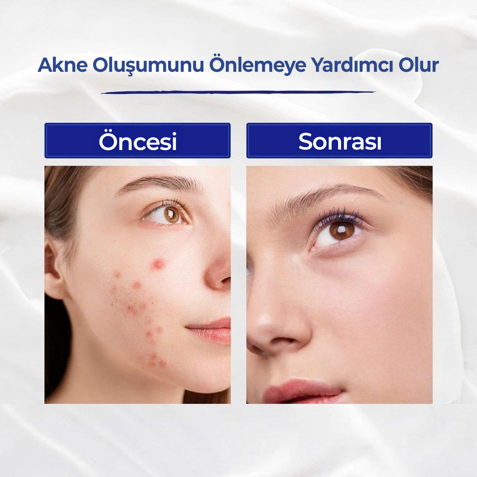 Akne oluşumunu önlemeye yardımcı olur